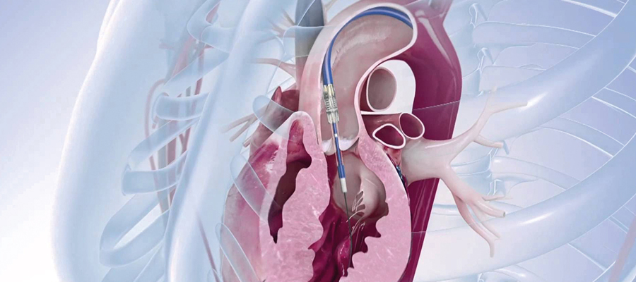 TAVI (Transcatheter Aortic Valve Implantation)