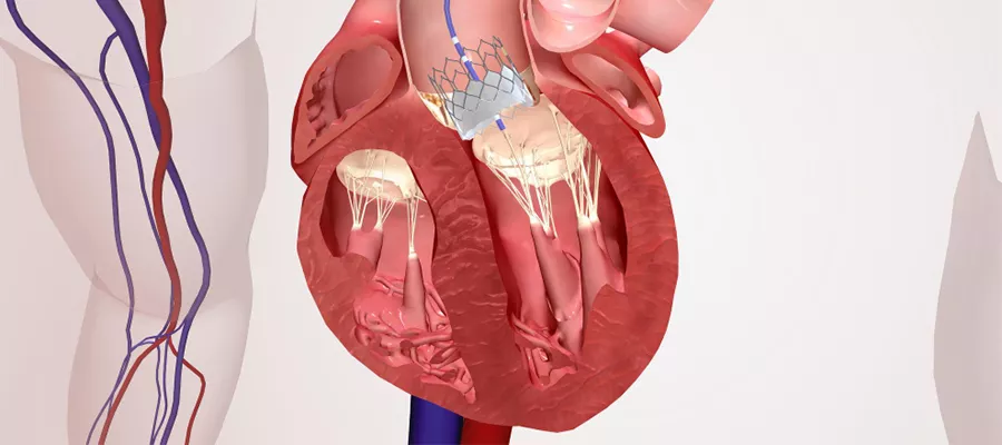 Patent Foramen Ovale (PFO)